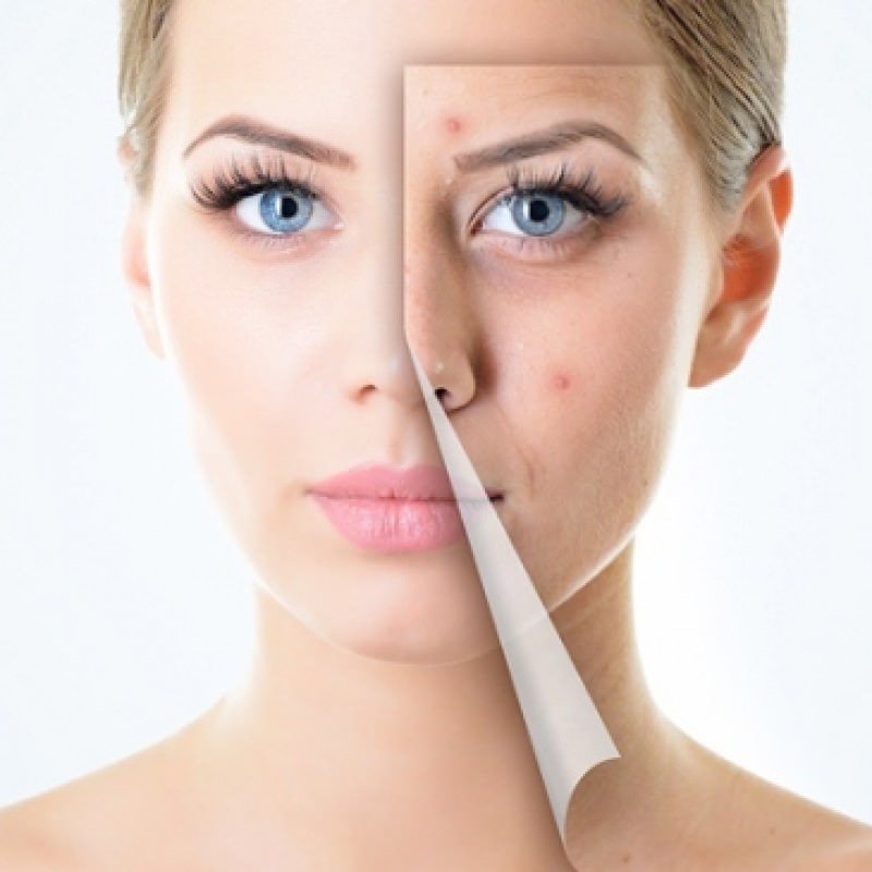 Best Acne Scars Treatment Products Acne Facts And Fictions & Best Scar