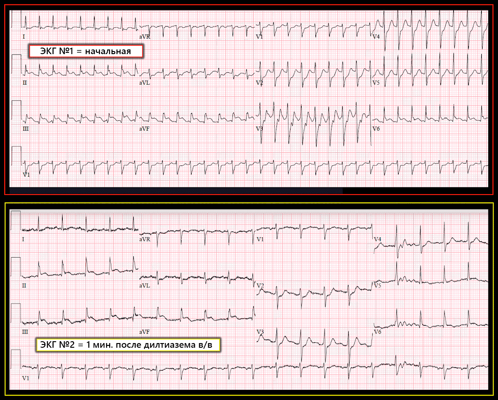 экг нарисовать. нормальная экг во всех отведениях 50мм. экг нарисовать. экг нарисовать. экг норма на миллиметровой бумаге.