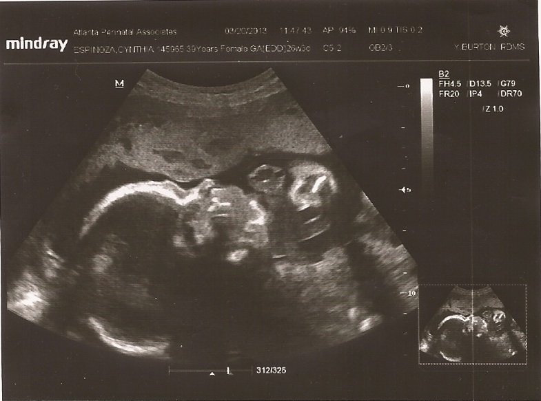 Viva Cindy: A Belly Comparison & Ultrasound Pics