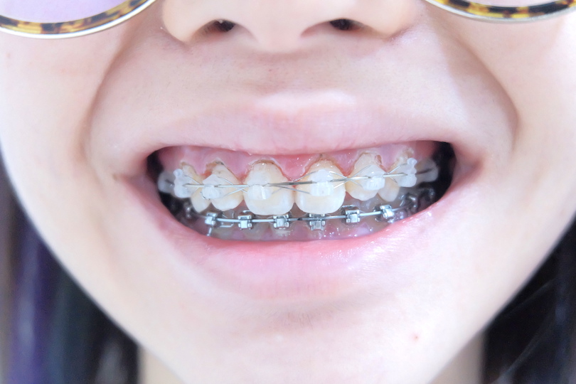 MY BRACES STORY 5 Laser Gum & Changes Travel & Beauty
