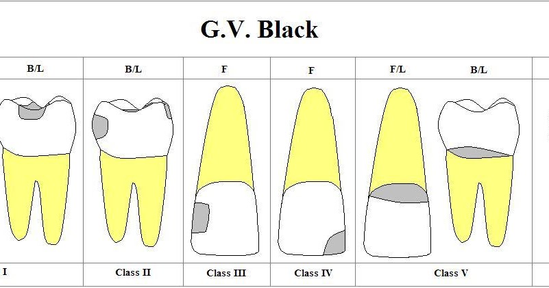 Классы по блэку в стоматологии в картинках