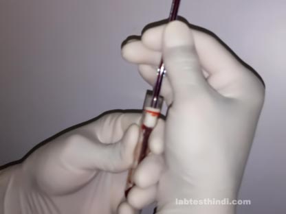 ESR Test कैसे लगाते हैं - latest Technique ~ Lab Test Hindi