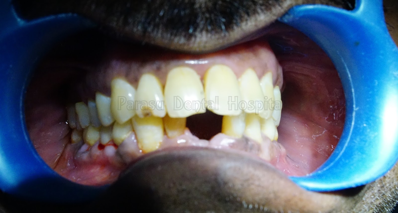 dental implants cost in chennai,India Missing Tooth Replacement in Chennai