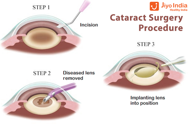 How common is cataract surgery