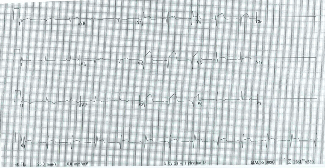 Dr Smith s ECG Blog An 8 Year Old With Diarrhea Abdominal Pain And Syncope