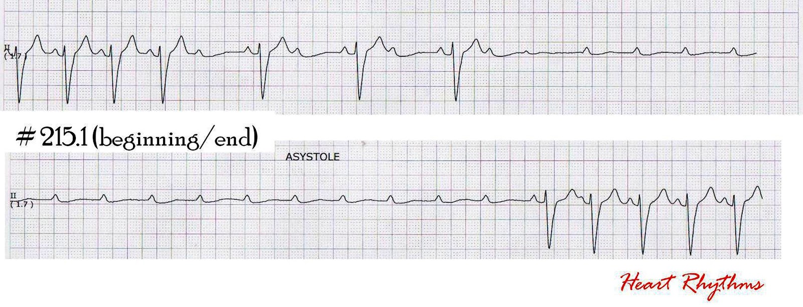 ECG Rhythms Paroxysmal AV block (Ventricular standstill)