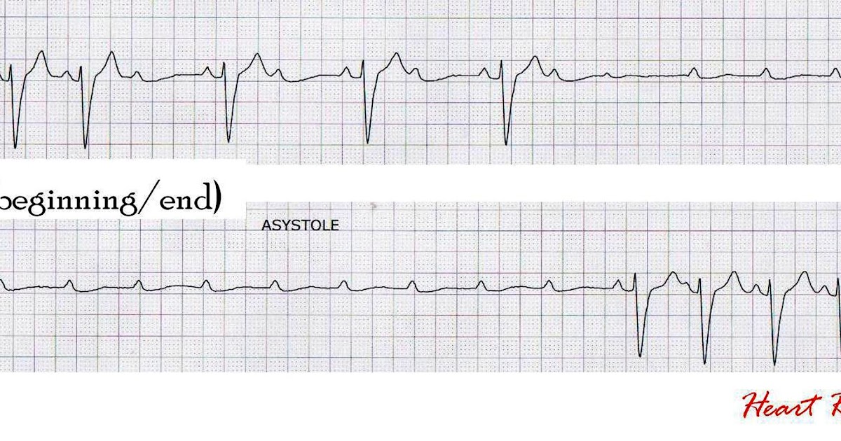 ECG Rhythms Paroxysmal AV block (Ventricular standstill)