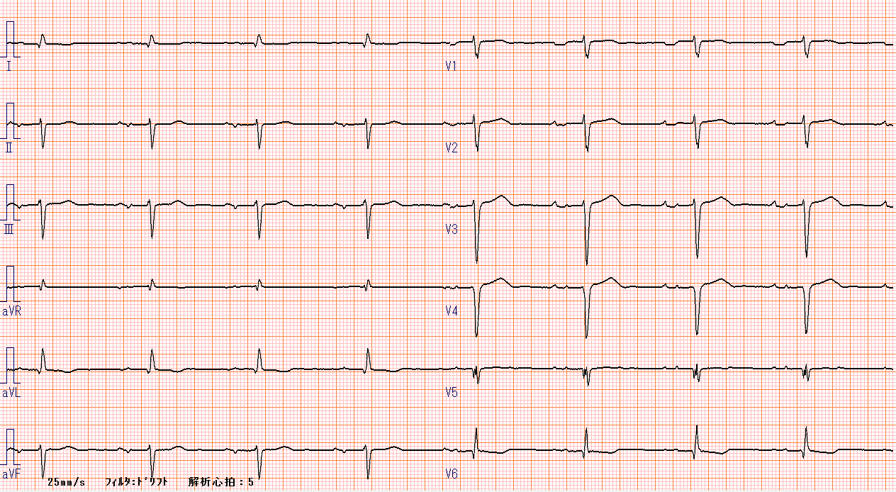 松下 Er ランチ カンファレンス 不思議な心電図 Wide P