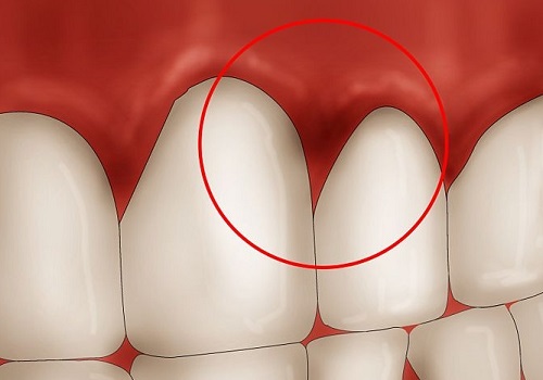triệu chứng viêm chân răng triệu chứng viêm chân răng