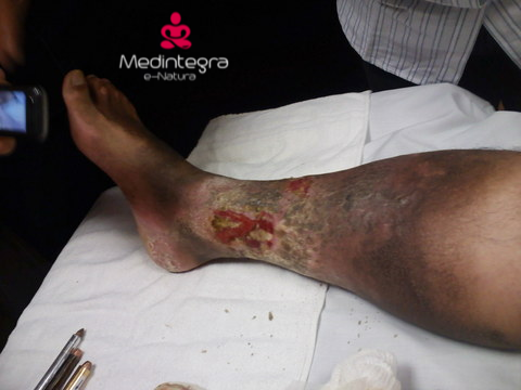 ulcera presión acupuntura Acupuntura Alicante