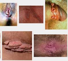 Obat Kutil Kelamin Ampuh Obat Kutil Kelamin Ampuh