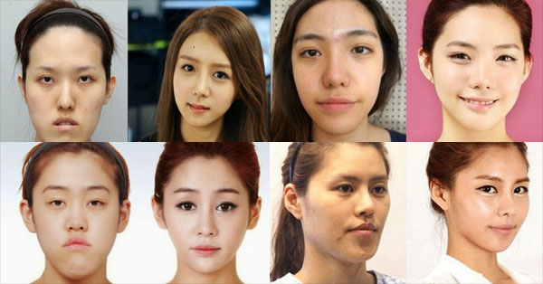 21 Plastic Surgeries In Korea That Will Surely Make You Believe In Magic! 21 Plastic Surgeries In Korea That Will Surely Make You Believe In Magic!