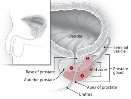 adenoma prostatico quando operare