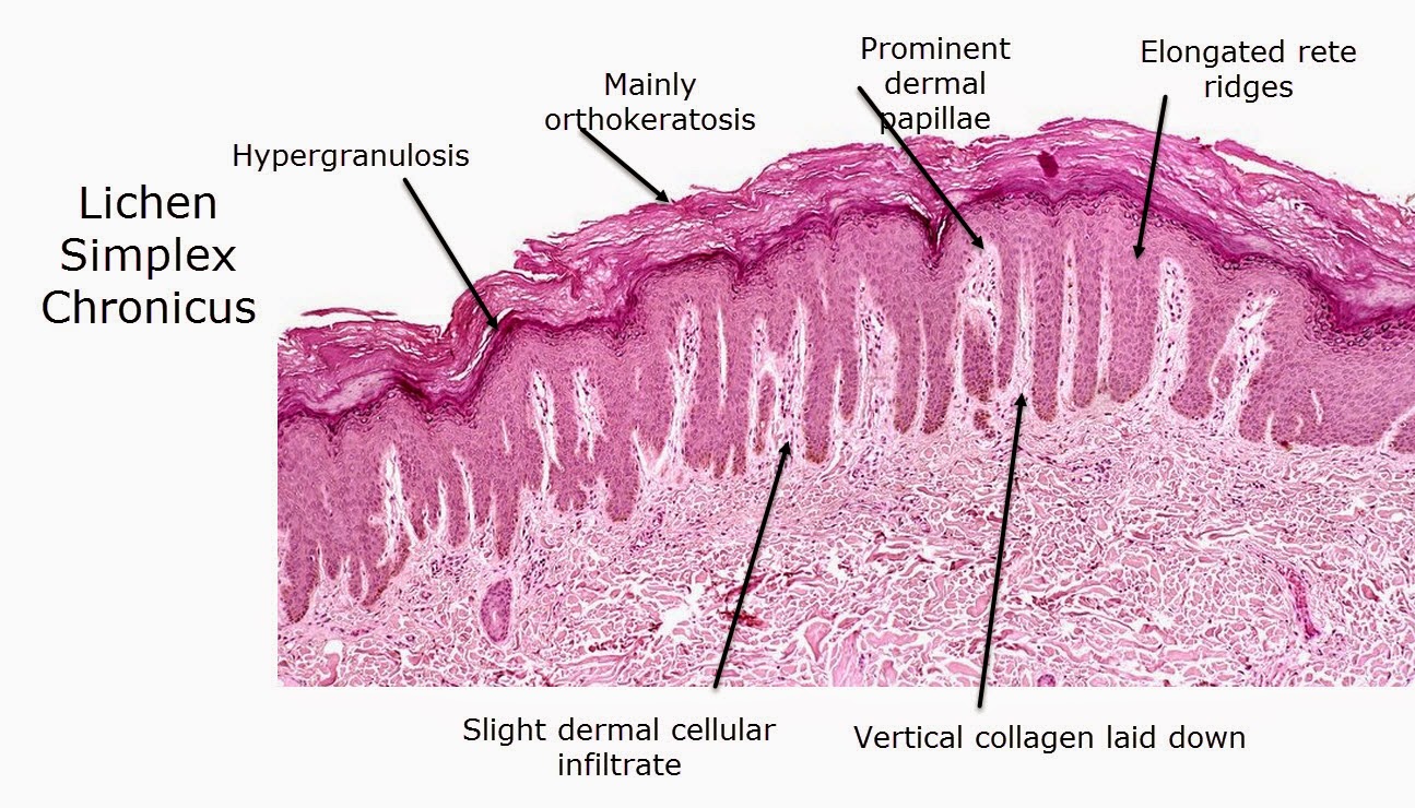 Inflammatory skin diseases | DermNet New Zealand