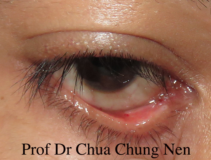 Eyelid Surgery by Prof Dr CN CHUA 蔡鐘能: Doctor, can you remove these ...