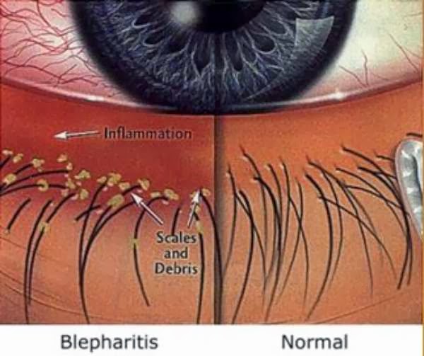 Inflamación del párpado: una enfermedad común del ojo