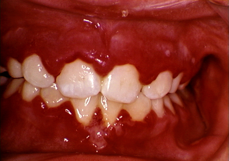 Study Medical Photos Description Of Mouth Ulcers With Pictures For