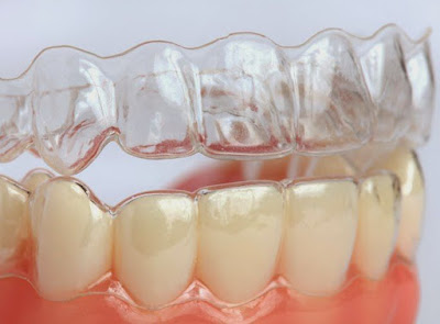 Niềng răng thẩm mỹ có an toàn không ?