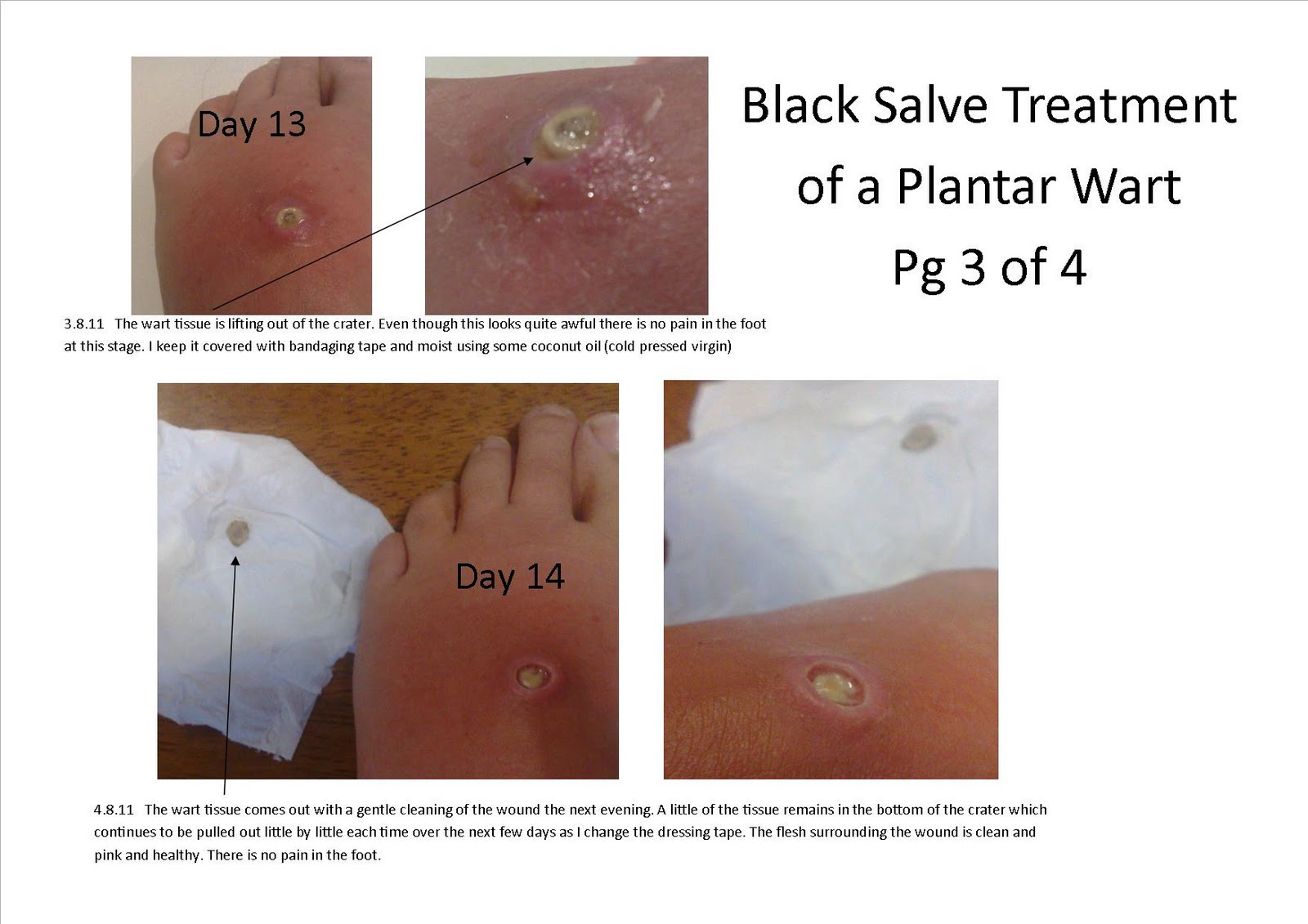 Holistic Therapy Connections Treatment of a Plantar Wart using Black Salve