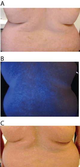 Mejora del vitiligo después del tratamiento del hipotiroidismo-fig-1