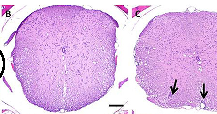 Multiple sclerosis research paper