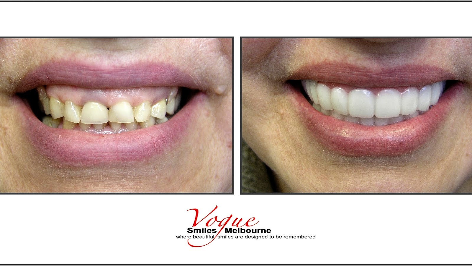 Can Porcelain Veneers Be Whitened White Choices
