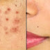 Pimples: How to Keep Your Skin Clean & Clear
