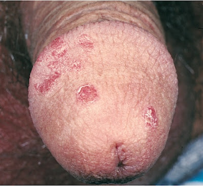 Psoriasis of the penis. Having begun a new sexual relationship 2 weeks previously