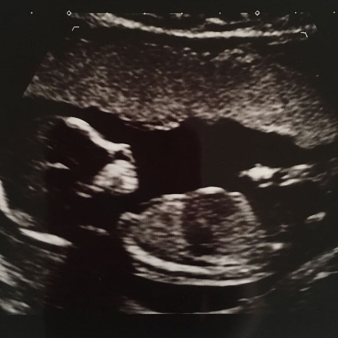 15 Haftalık Gebelik Ultrason Görüntüleri