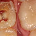 Thế nào là viêm chân răng implant ?