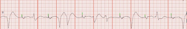 ECG Rhythm Strip Quiz 77