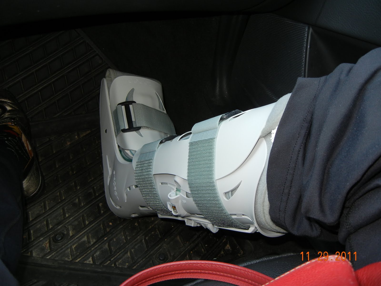 Downs Bunion Surgery 11.17.2011 Hallux Valgus Deformity