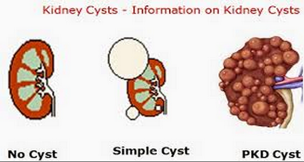 treatment for kidney disease: What Happens When a Kidney (Renal) Cyst Ruptures