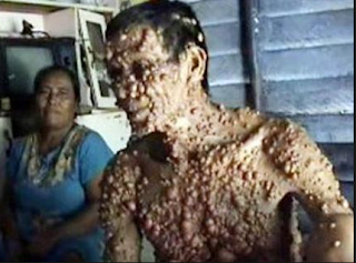 Foto Cara Menghilangkan Kutil Kelamin Dengan Obat Kutil Di Apotik Herbal