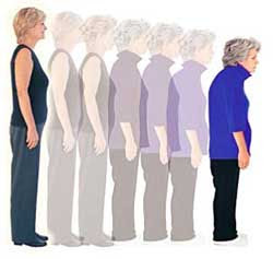 Osteoporose