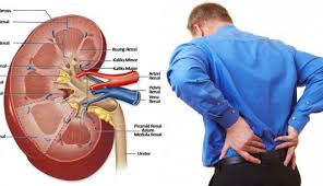 Obat Ampuh mengatasi penyakit batu ginjal dan memulihkan fungsi ginjal