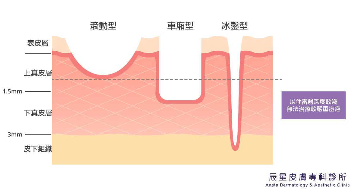痘疤類型中,大致分為色素型疤痕、凸疤及凹疤,其中凹疤治療甚為棘手
