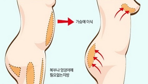 nâng ngực bằng mỡ tự thân có an toàn