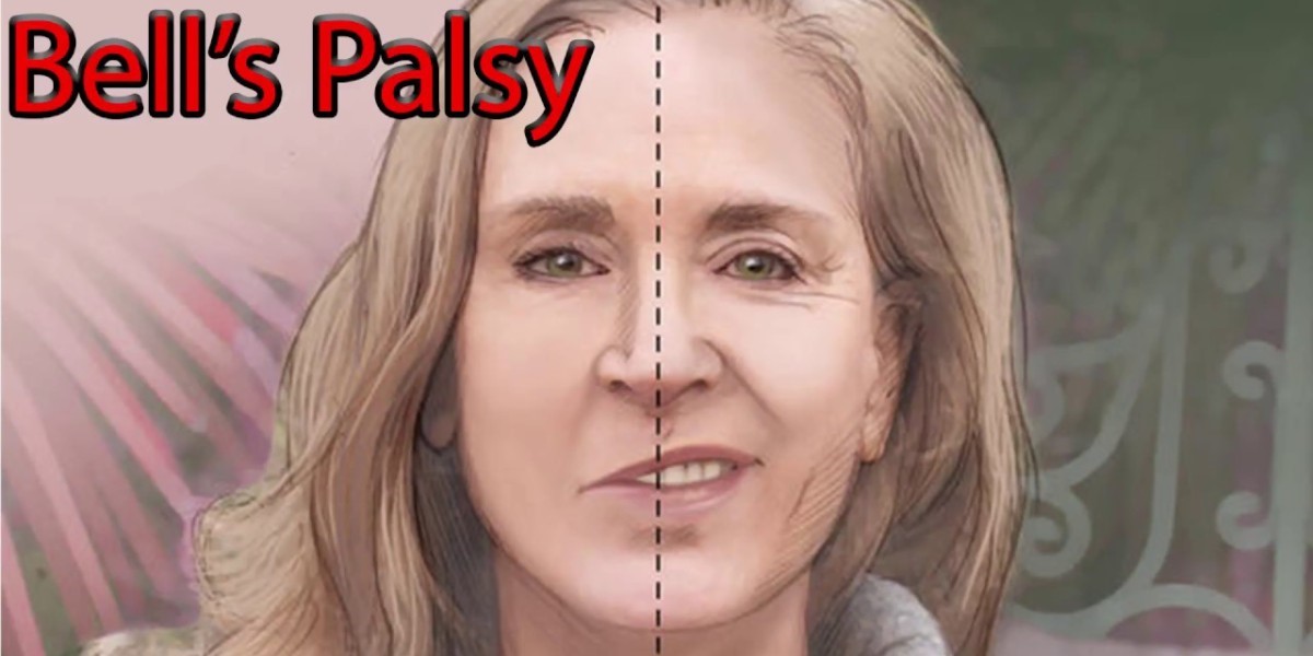 Cara Mengobati Wajah Lumpuh Sebelah Karena Bell's Palsy Cara Mengobati Wajah Lumpuh Sebelah Karena Bell's Palsy
