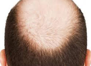 Sac Ekimi Istanbul Da Sac Ekimi Islemi Ve Fiyatlari