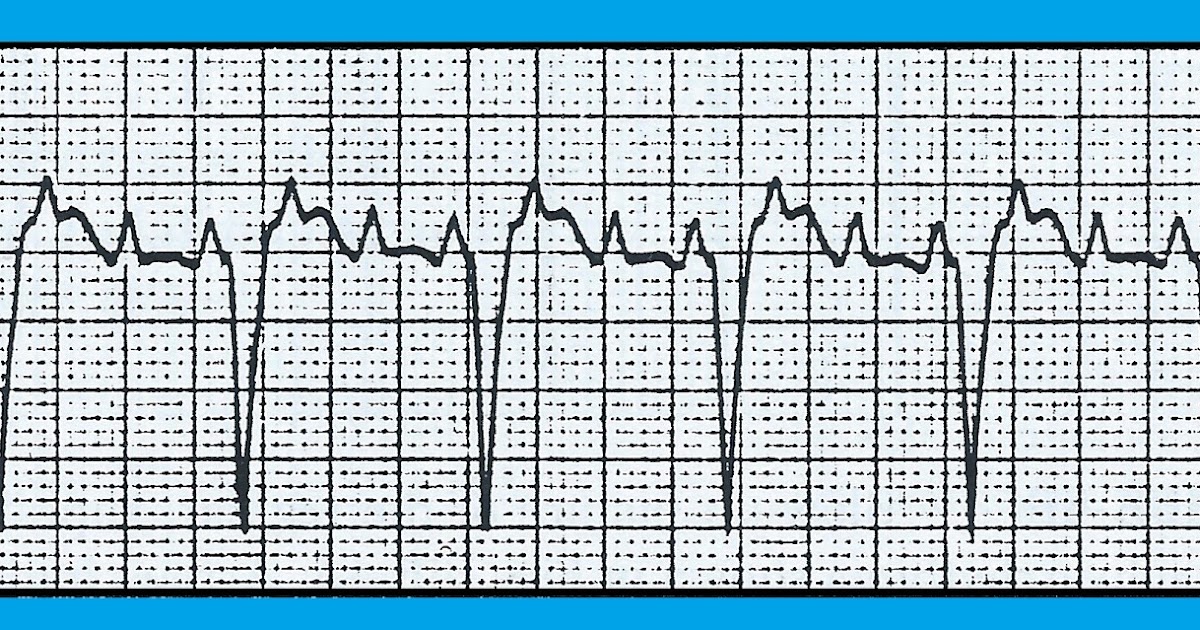 ECG Interpretation: ECG Blog #137 (SVT – AV Block – Atrial Flutter ...