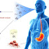 Τεστ αναπνοής ανιχνεύει καρκίνο του οισοφάγου και του στομάχου