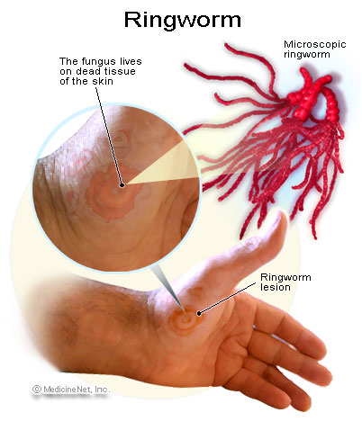 Free For Health: What Does Ringworm Look Like? The Tell Tale Signs
