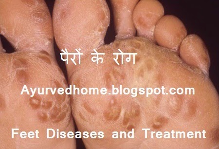 Diseases Of The Feet And Treatment,  पैरों के रोग व उपचार,  Pairo ke Rog