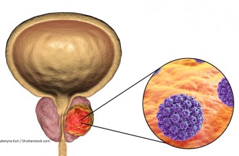 Tratamiento del alto puntaje de Gleason del cáncer de próstata