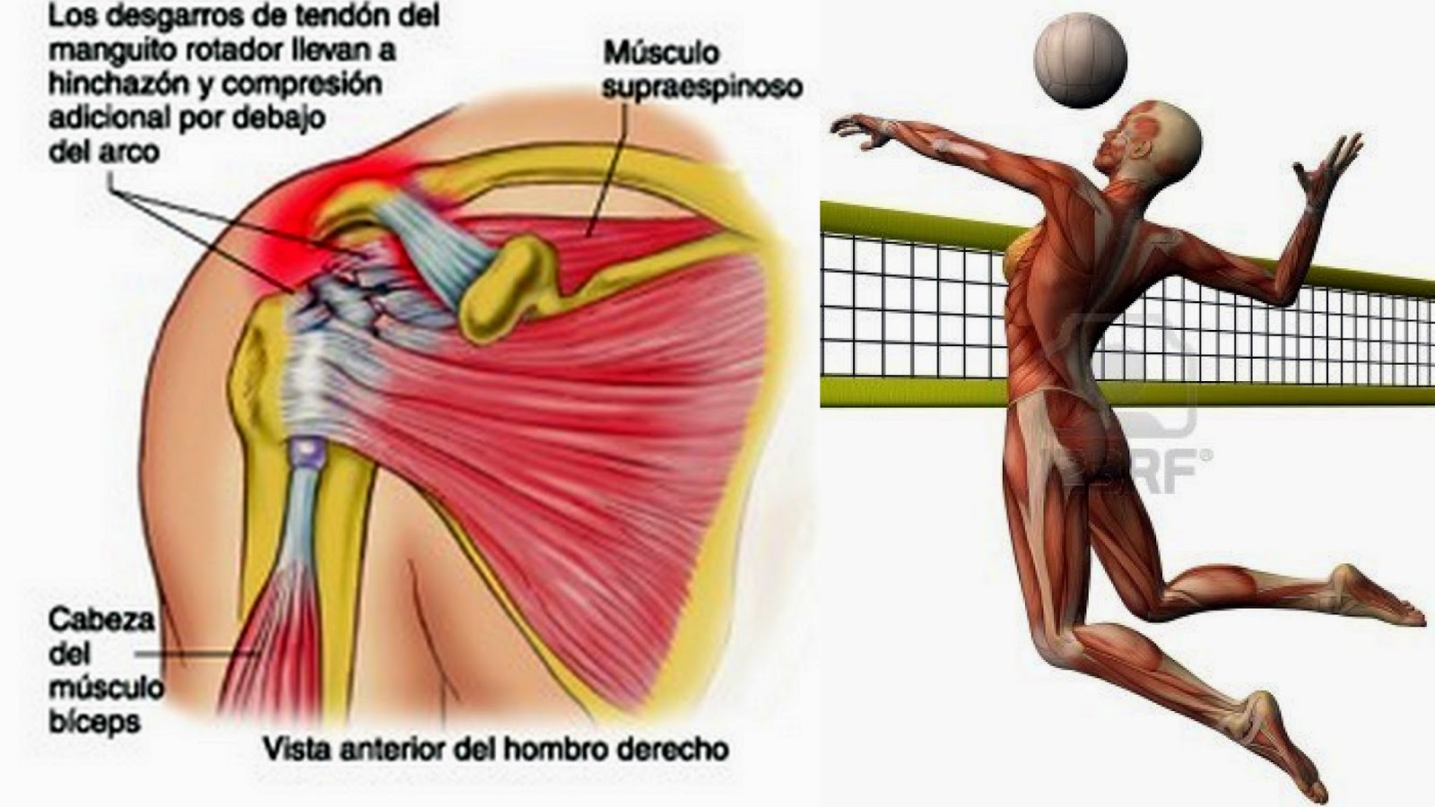 dolor hombro voley
