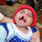 Mengatasi bibir sumbing Info Kesehatan Indonesia