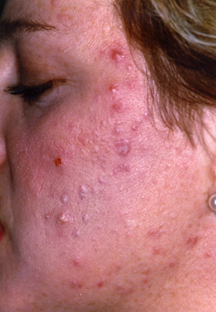 about acne vulgaris