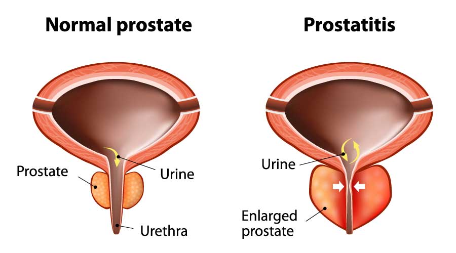 prosztatitis alatt pills a krónikus prostatitis vélemények