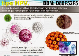 Obat kutil kemaluan kelamin obat kutil - di kulit kemaluan kelamin, penis pria laki-laki, vagina luar dan dalam, perempuan wanita Ibu hamil menyusui mengandung, obat penghilang kutil menghilangkan kutil tanpa operasi yang terbukti dan aman terpercaya, obat penghilang kutil di kelamin, anus dubur, paha dsb